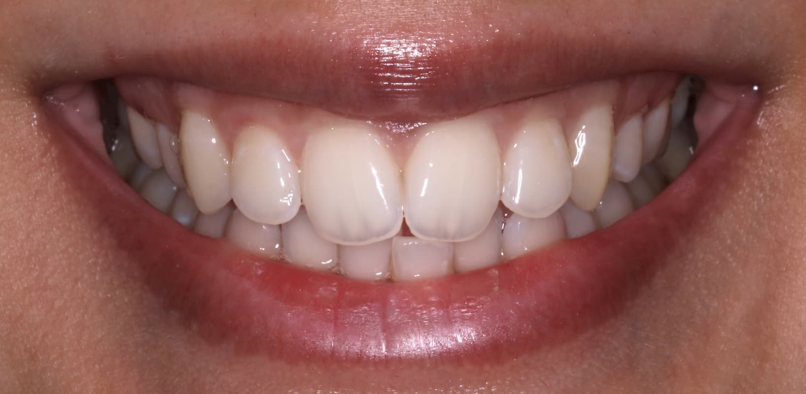 whitening after OK