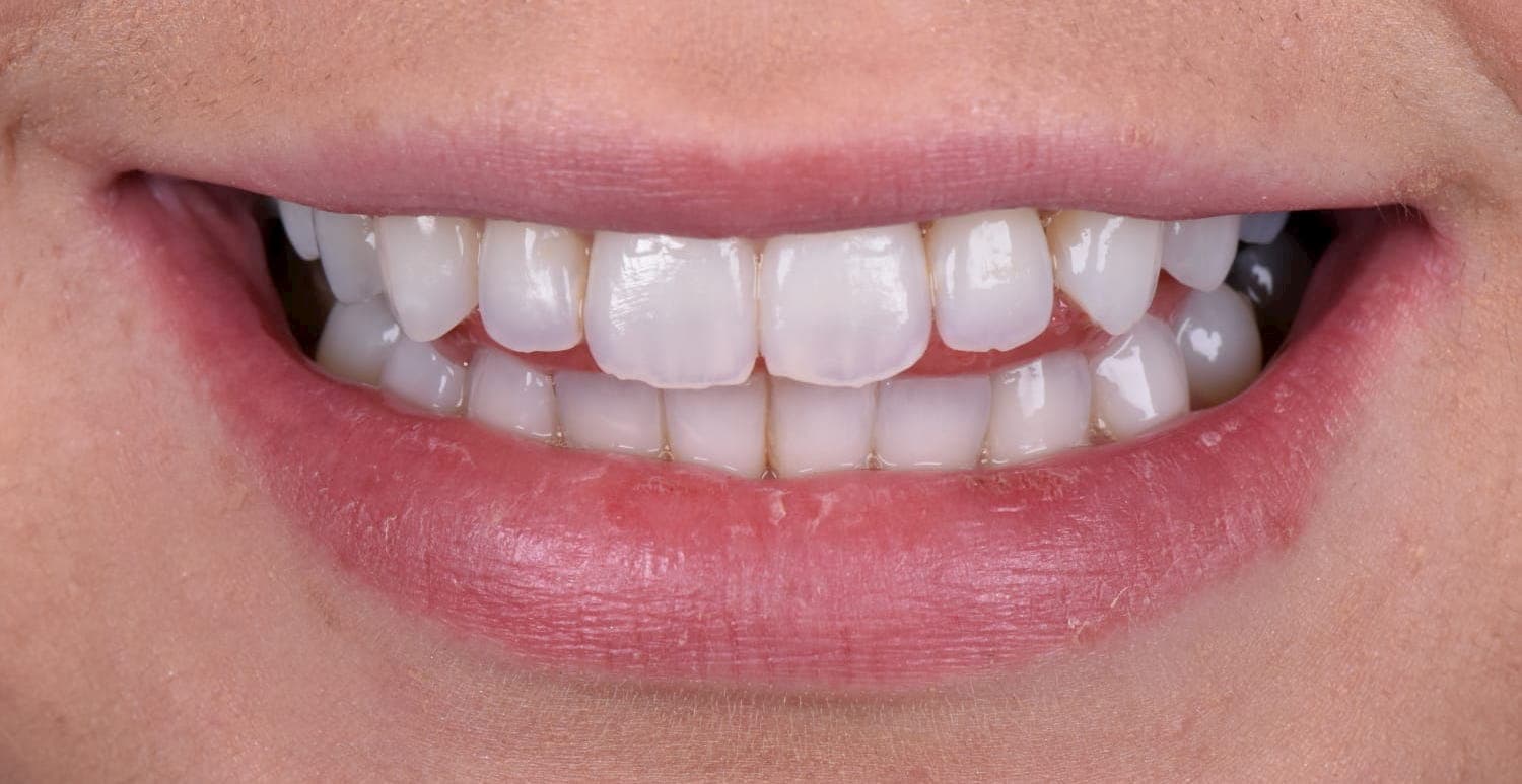 Invisalign 3 After