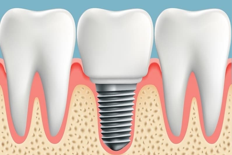 implants2
