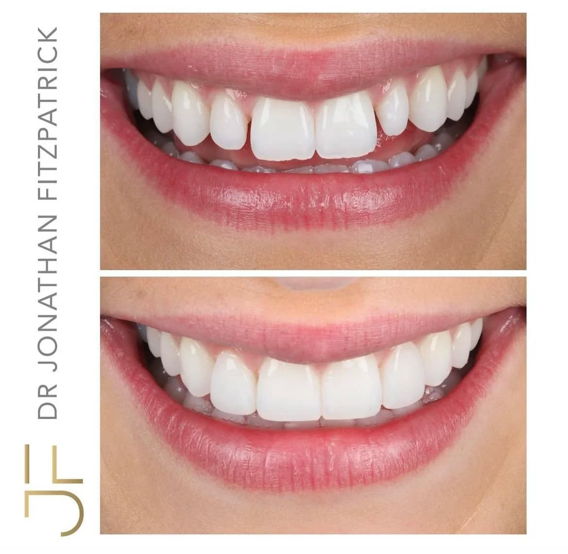 Invisalign x Bonding