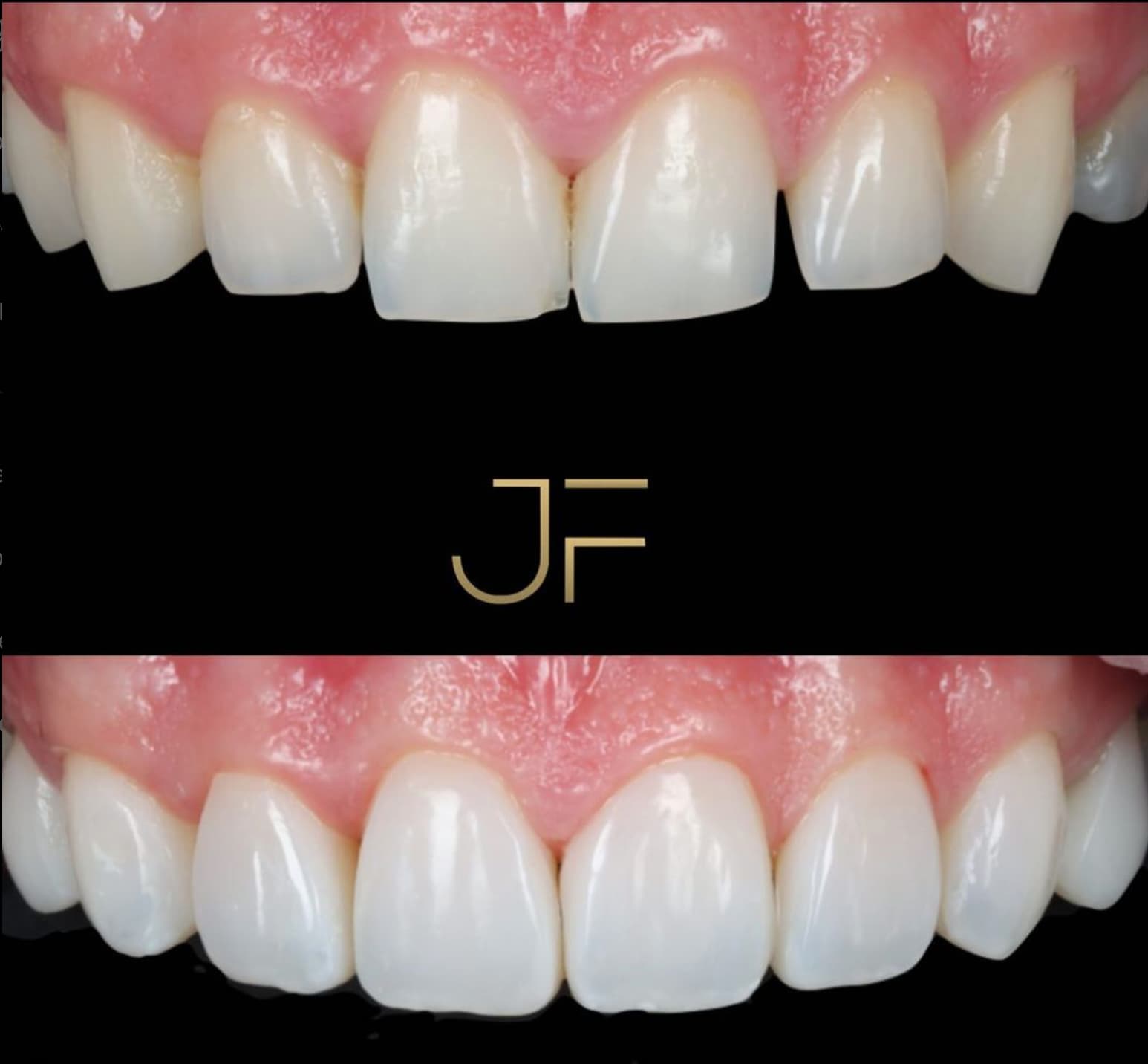 Composite Veneers