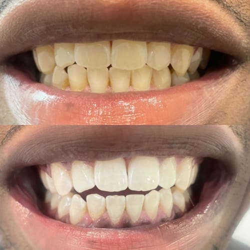 A third client's teeth before an after self administered teeth whitening