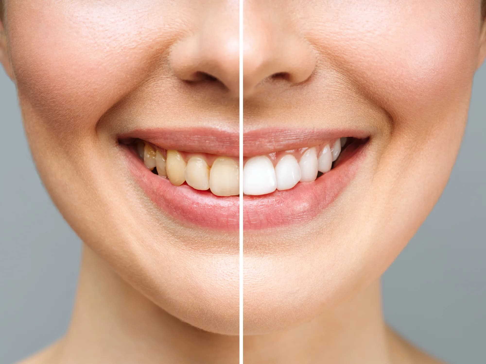 teeth whitening before after 2000