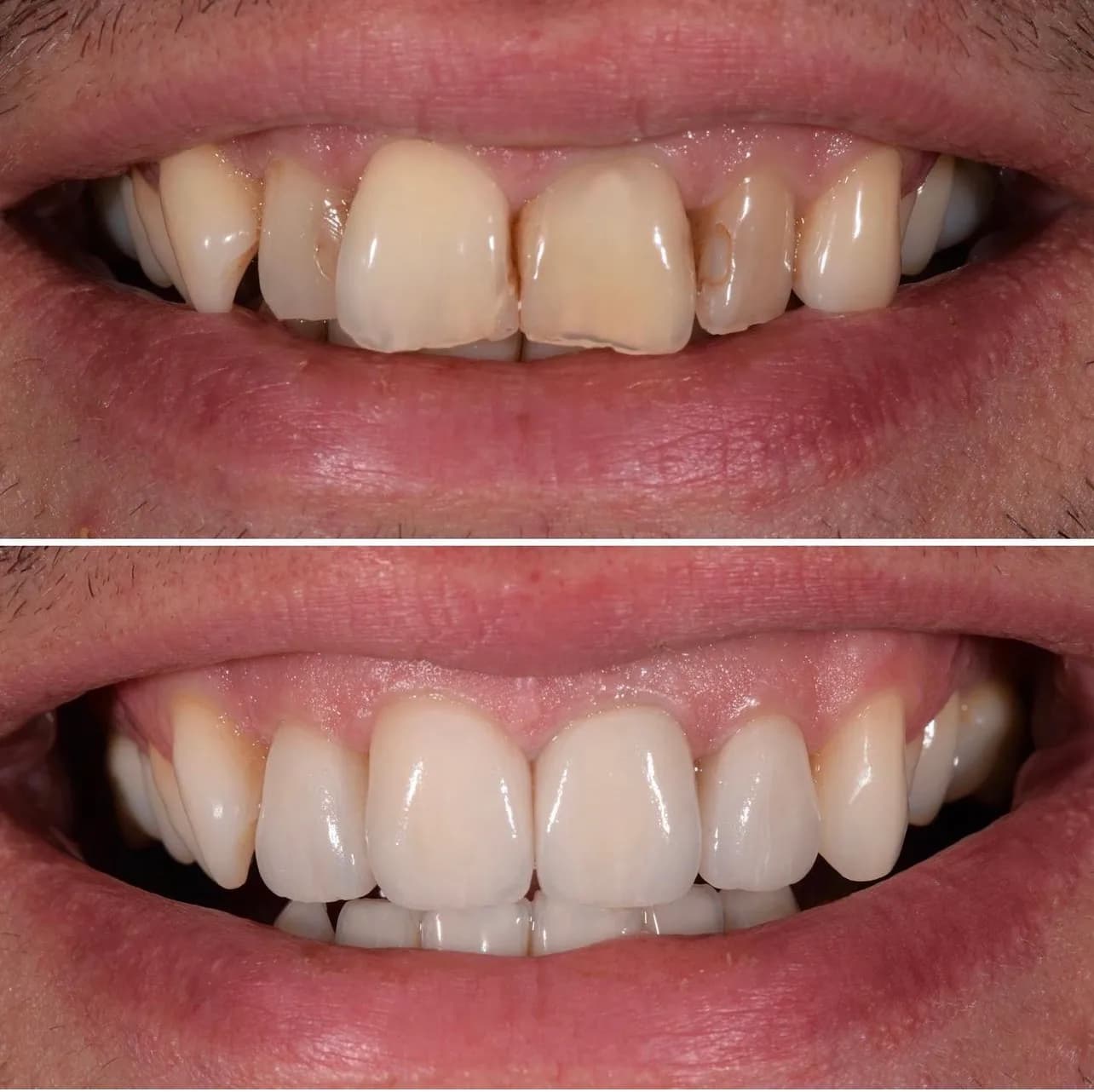 before after crown and veneer