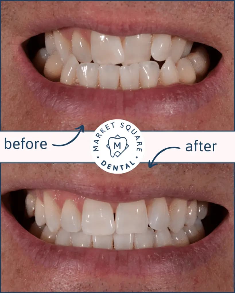 Copy of Teeth straightening 1 min 819x1024