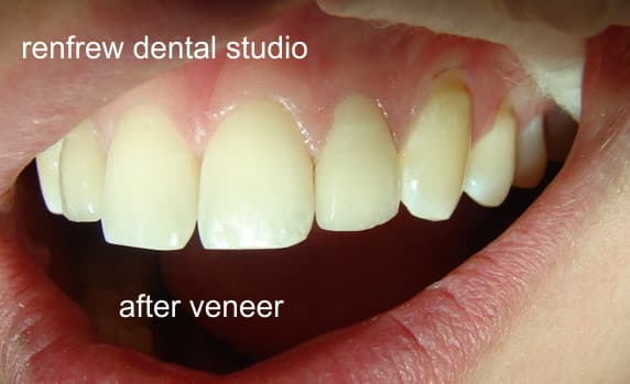 veneer2
