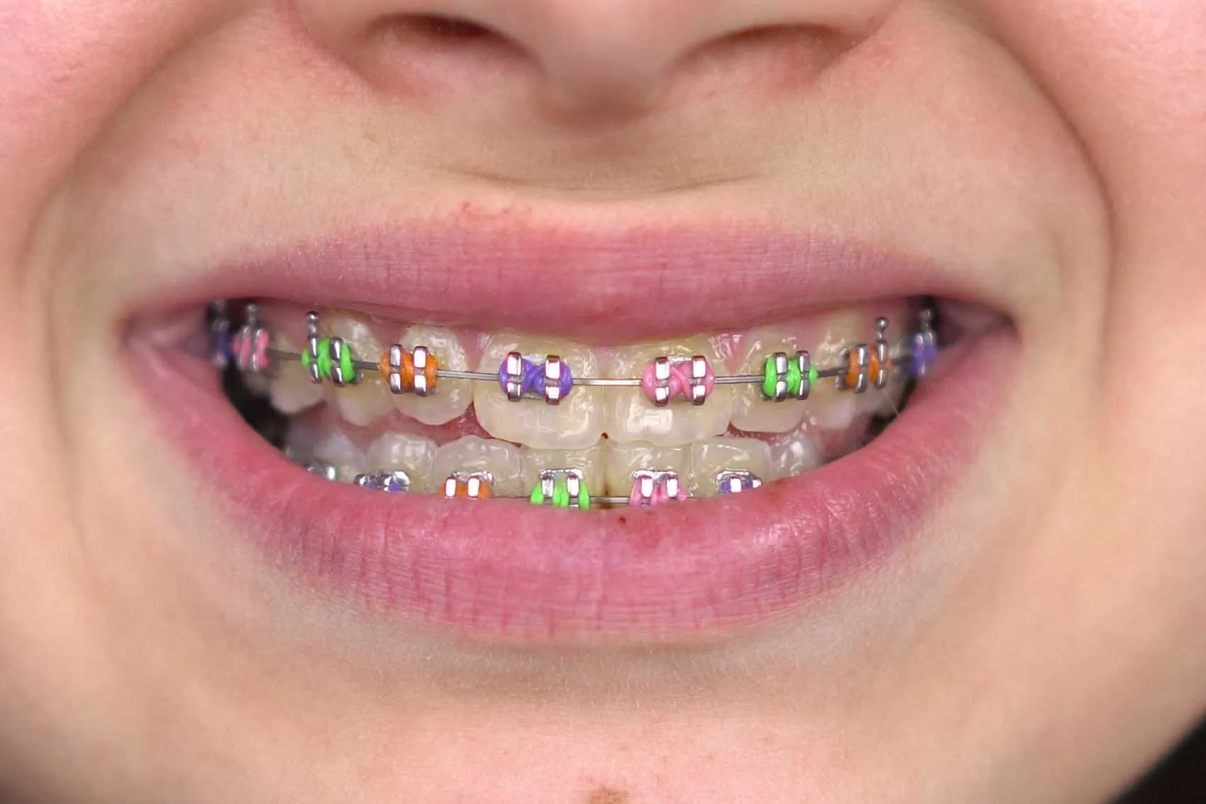treatment braces