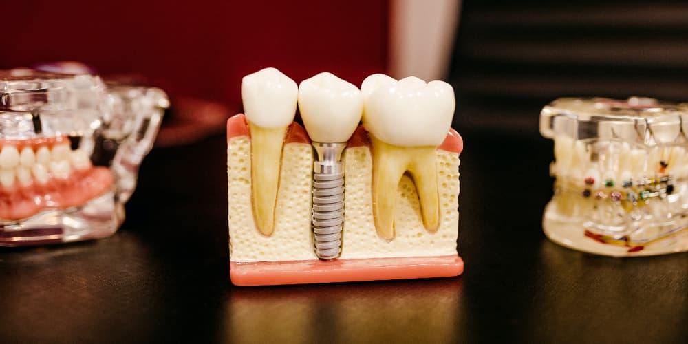 65153081849200094e8e8c41 are dental implants right for me