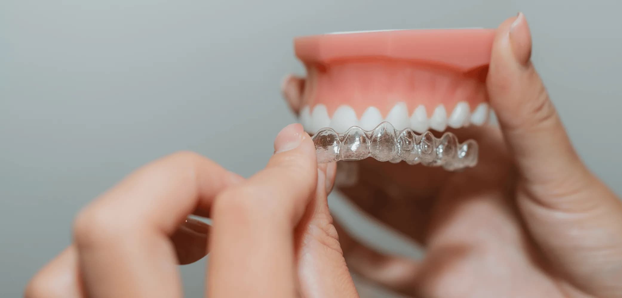 Invisalign clear aligners.