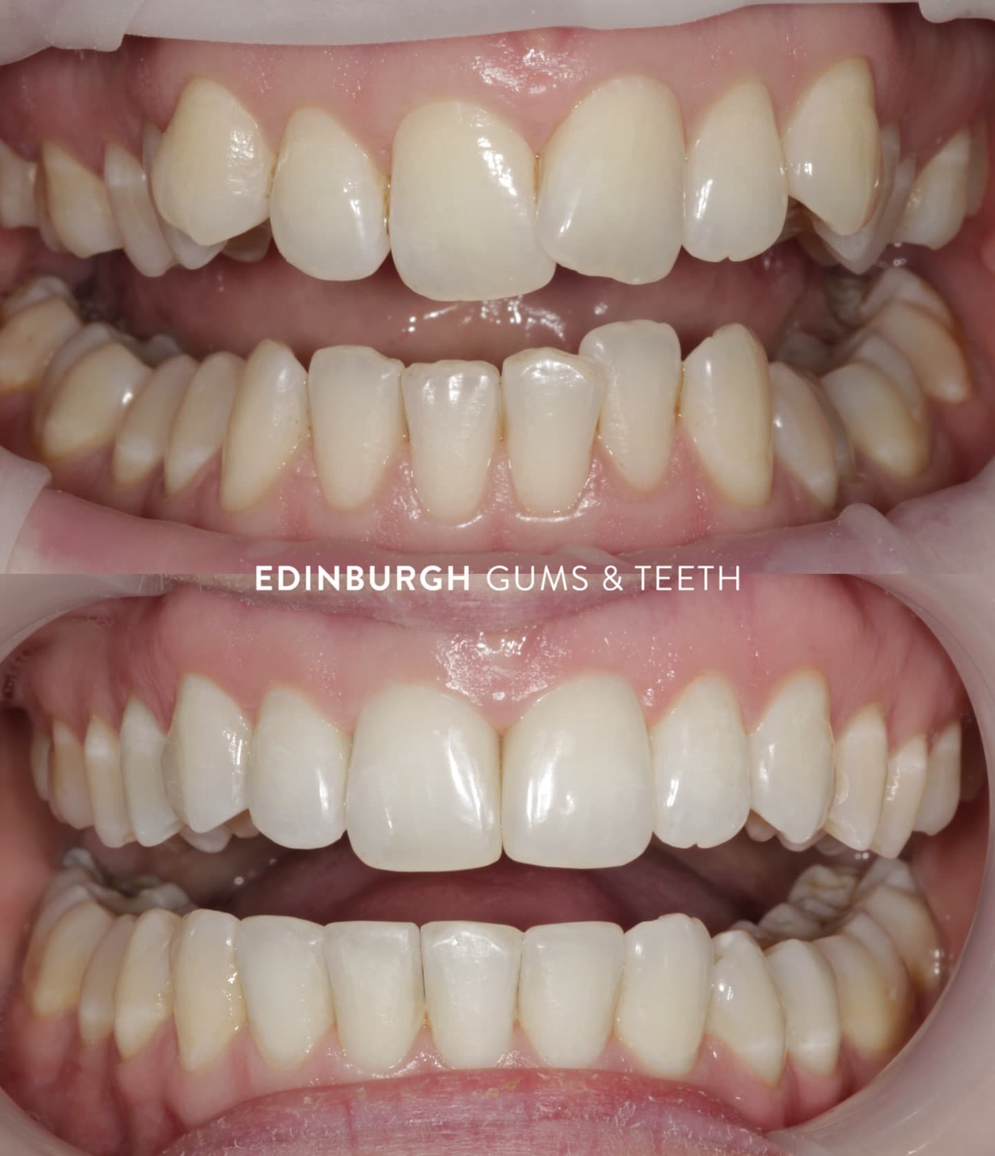 Straight teeth, but still your smile #edinburghgumsandteeth
