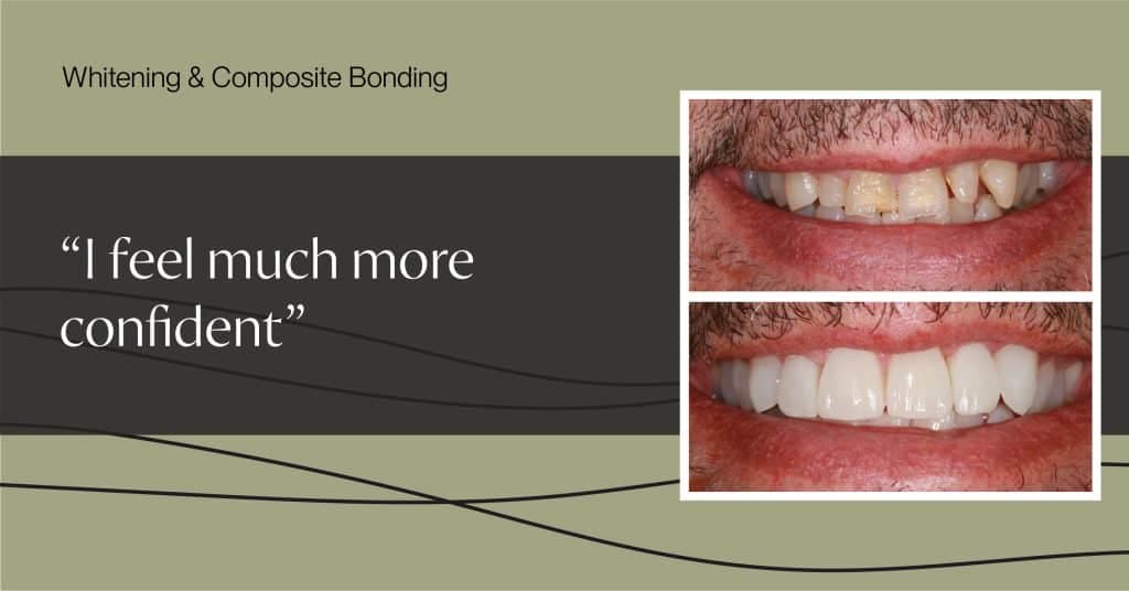 Whitening and Composite Bonding Martin 1024x536