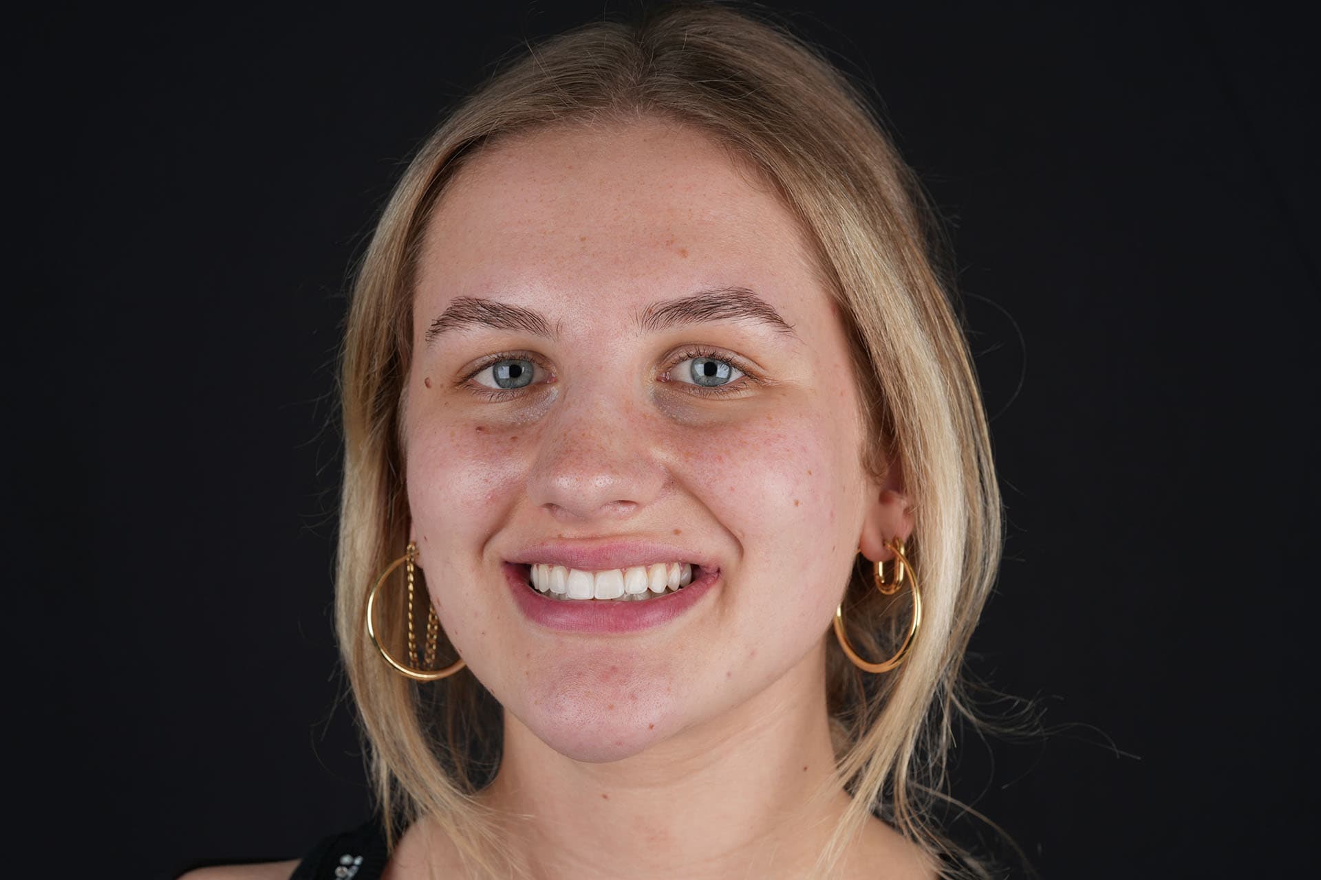 Image of Invisalign® aligners