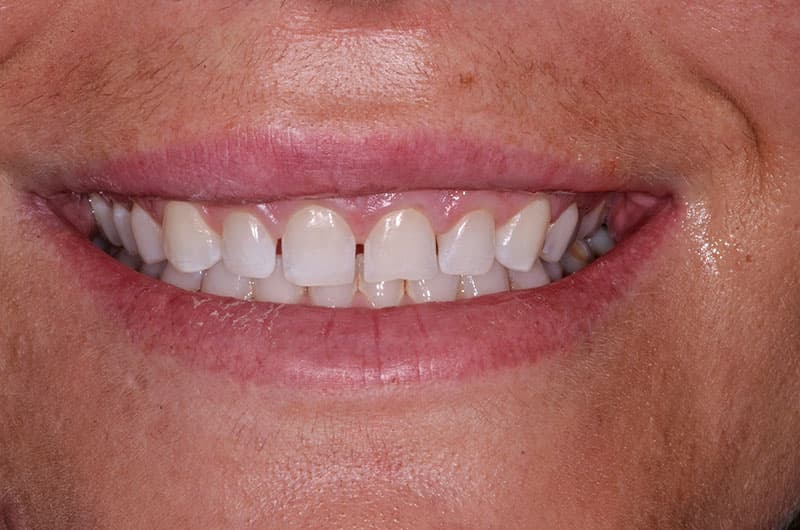 cosmetic bonding1 before