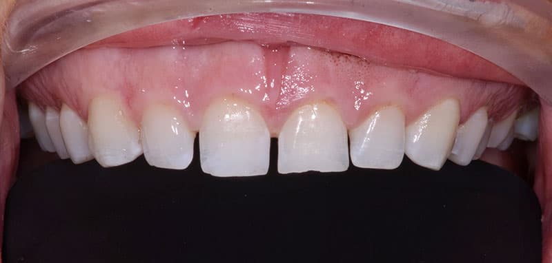 Before Cosmetic Bonding Treatment