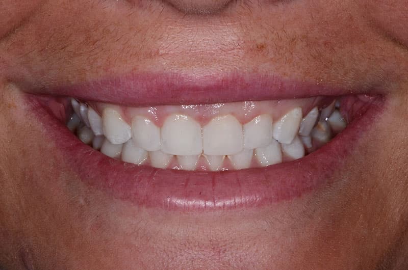 After Cosmetic Bonding Treatment