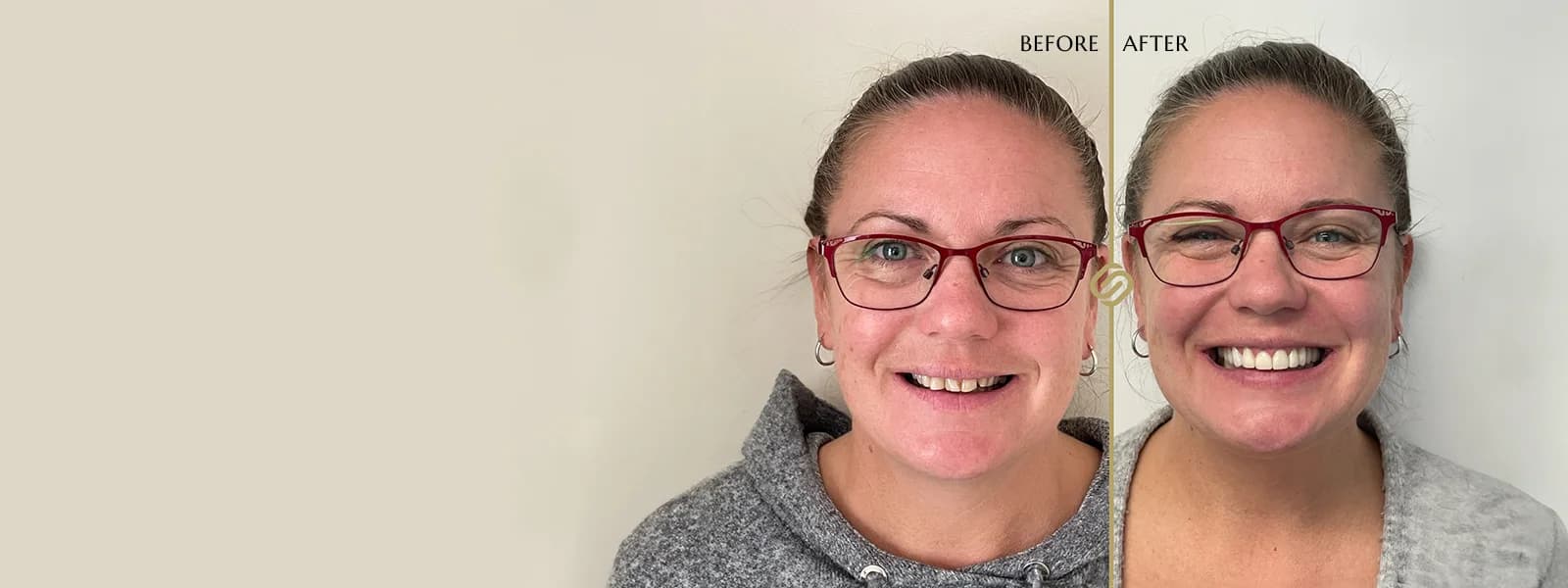 Free Smile Makeover Consultations