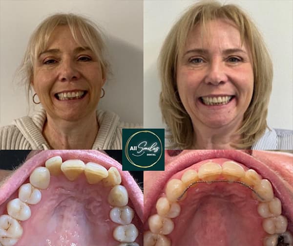 invisalign