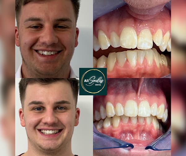 invisalign