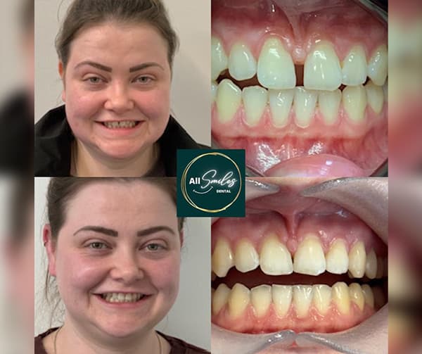 invisalign