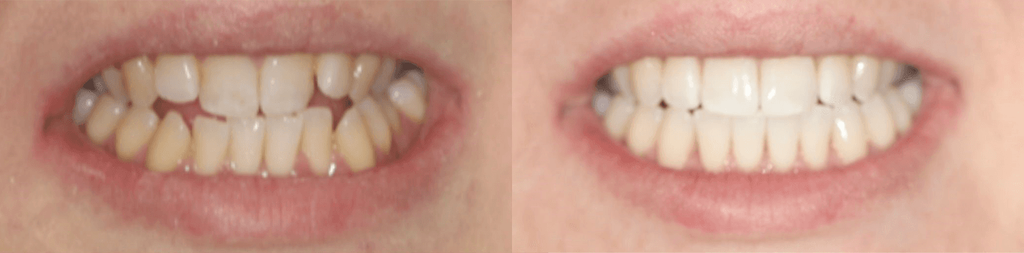 ba4