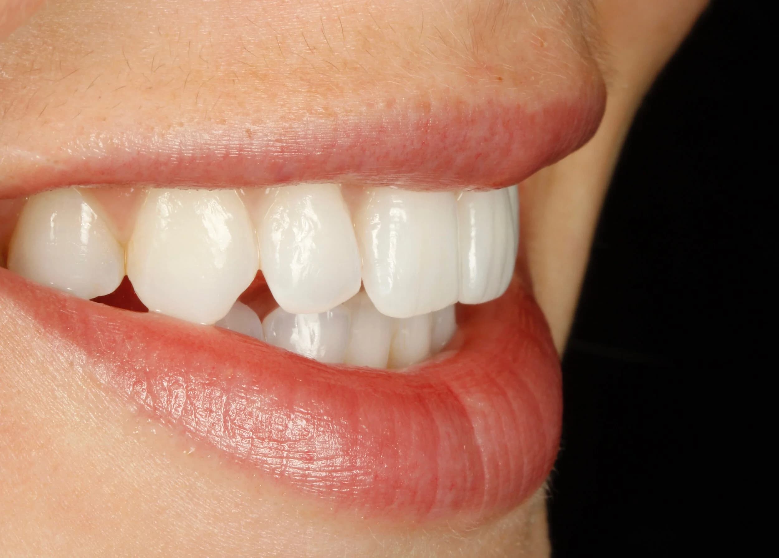 Close up of a person's smile showing white, straight teeth and pink lips created by expert Apex Invisalign provider at sheffield cleat braces
