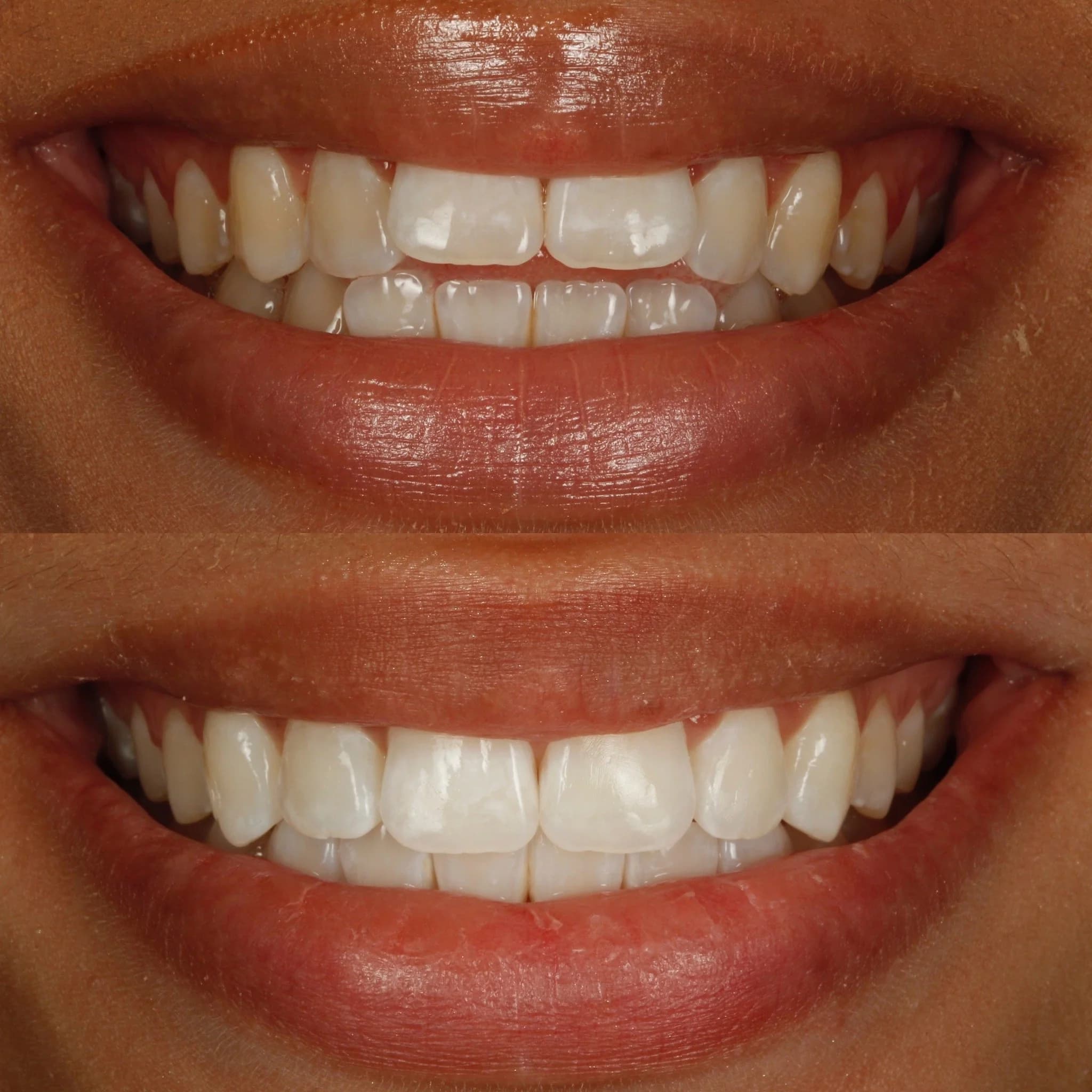 Close up of a person's smiling mouth showing their teeth, in the before and after Invisalign and teeth whitening by Dr Tom Lotka.