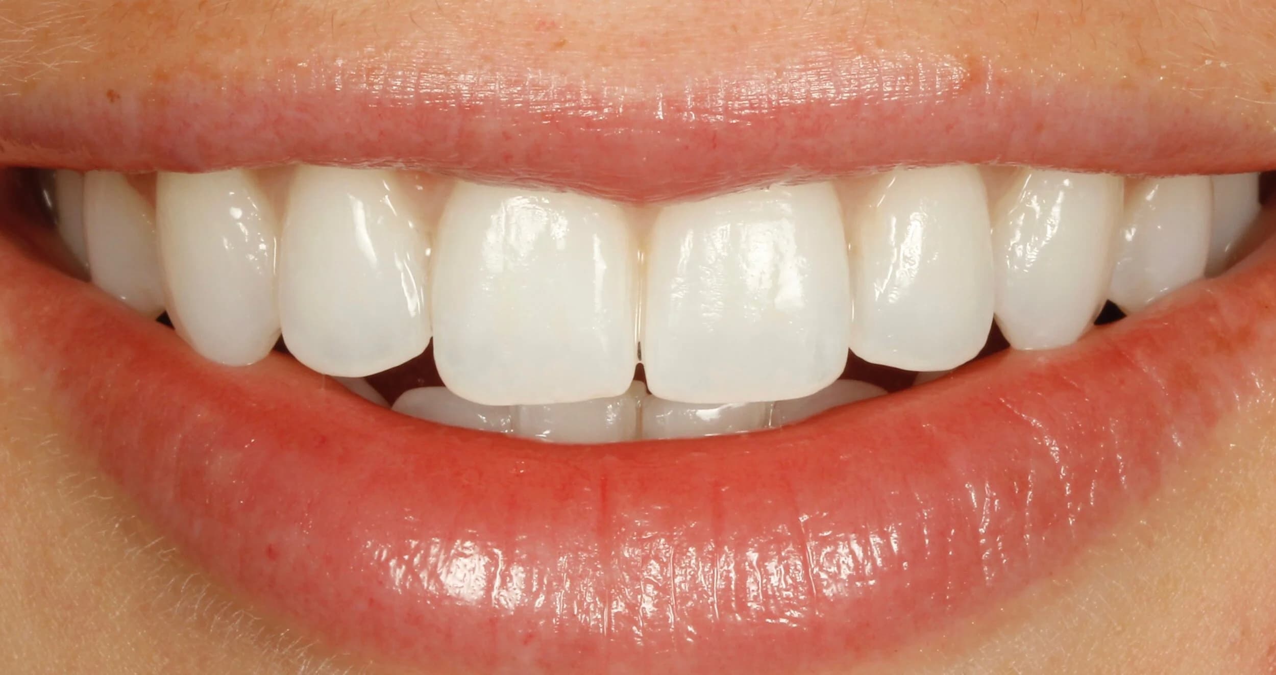 Beautiful smile after Invisalign ® here at Sheffield clear Braces.