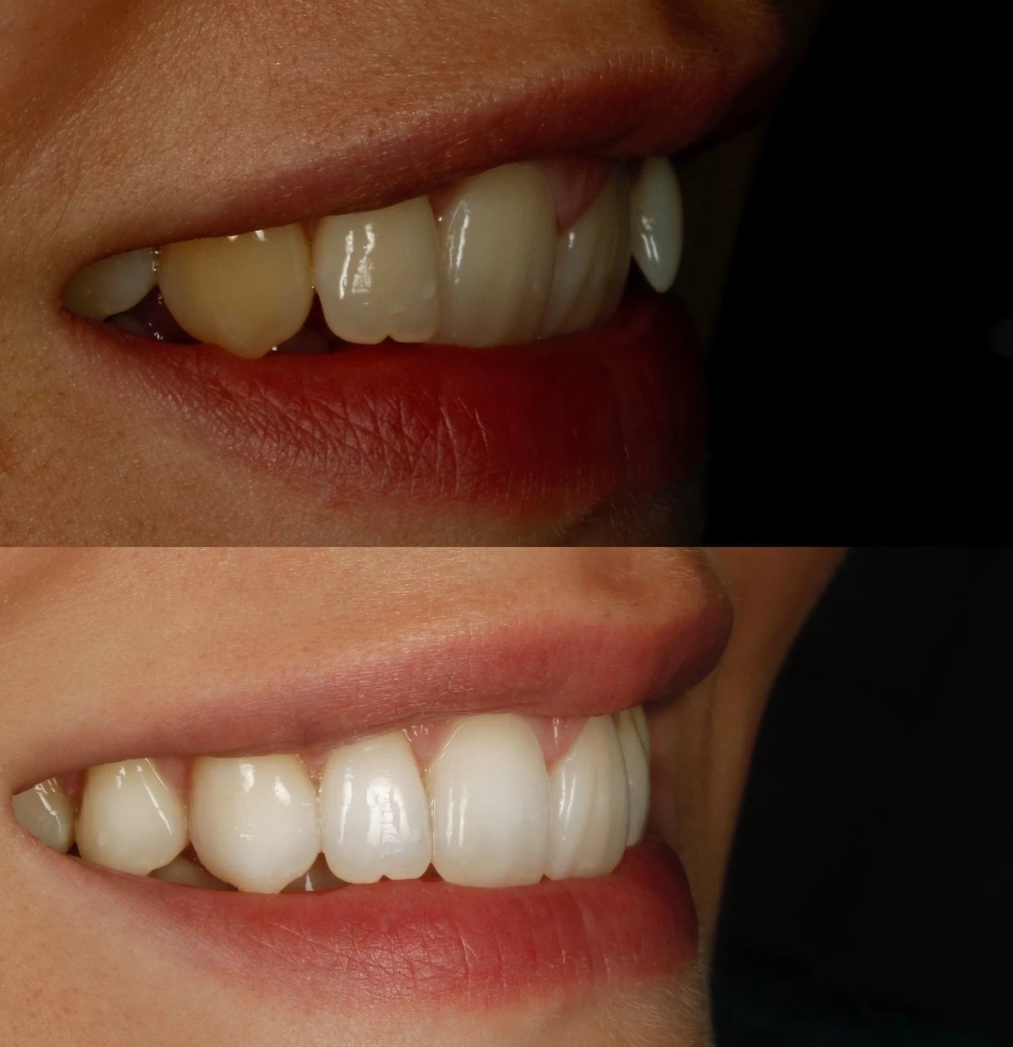 Comparison of teeth before and after whitening and Invisalign showing brighter, whiter teeth, straighter teeth in the bottom image.