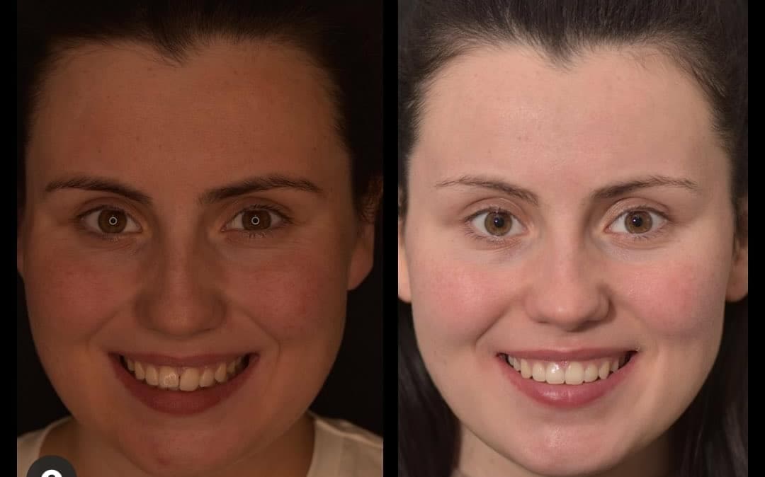 Invisalign Go