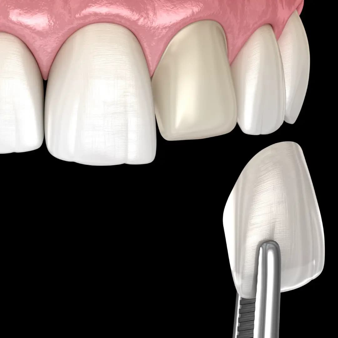 veneers