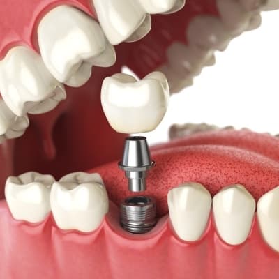 Dental implant Example