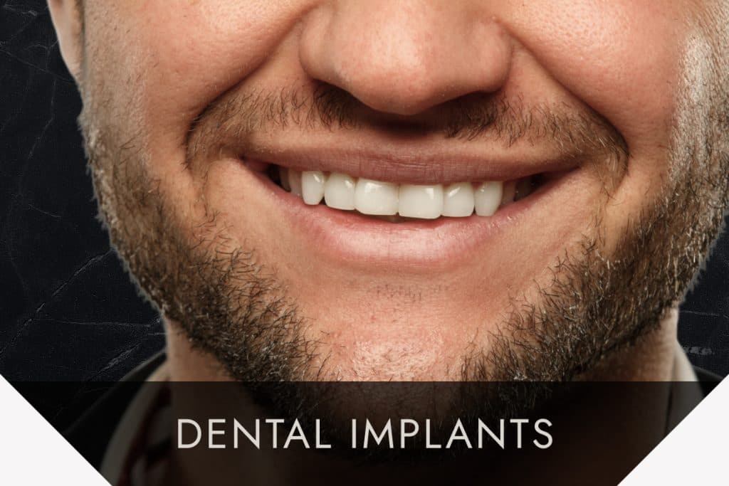 Man with dental implants smiling