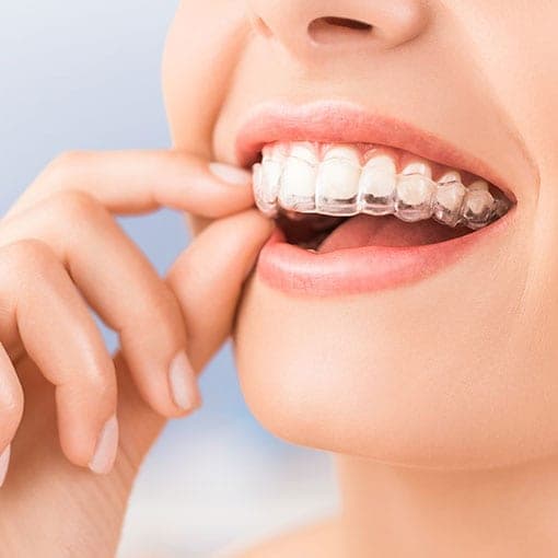 invisalign