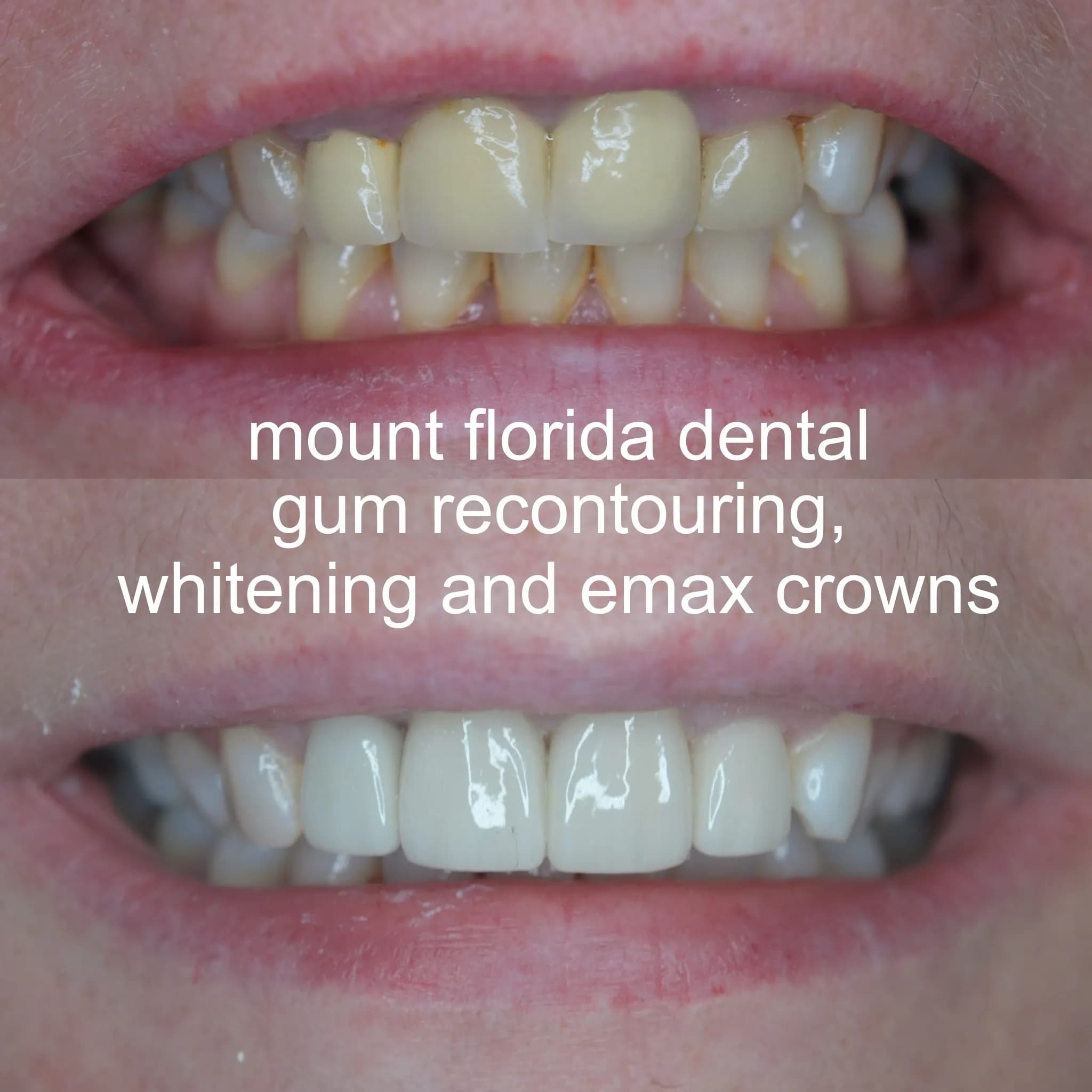 cosmetic smile make over with crowns tooth whitening