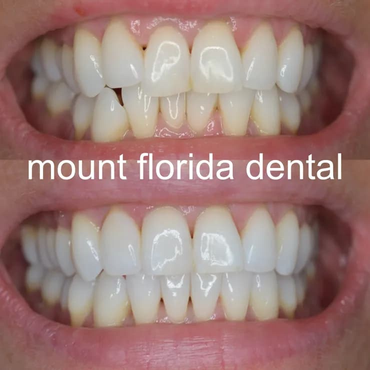 cosmetic orthodontics straightening crowded teeth and tooth bleaching
