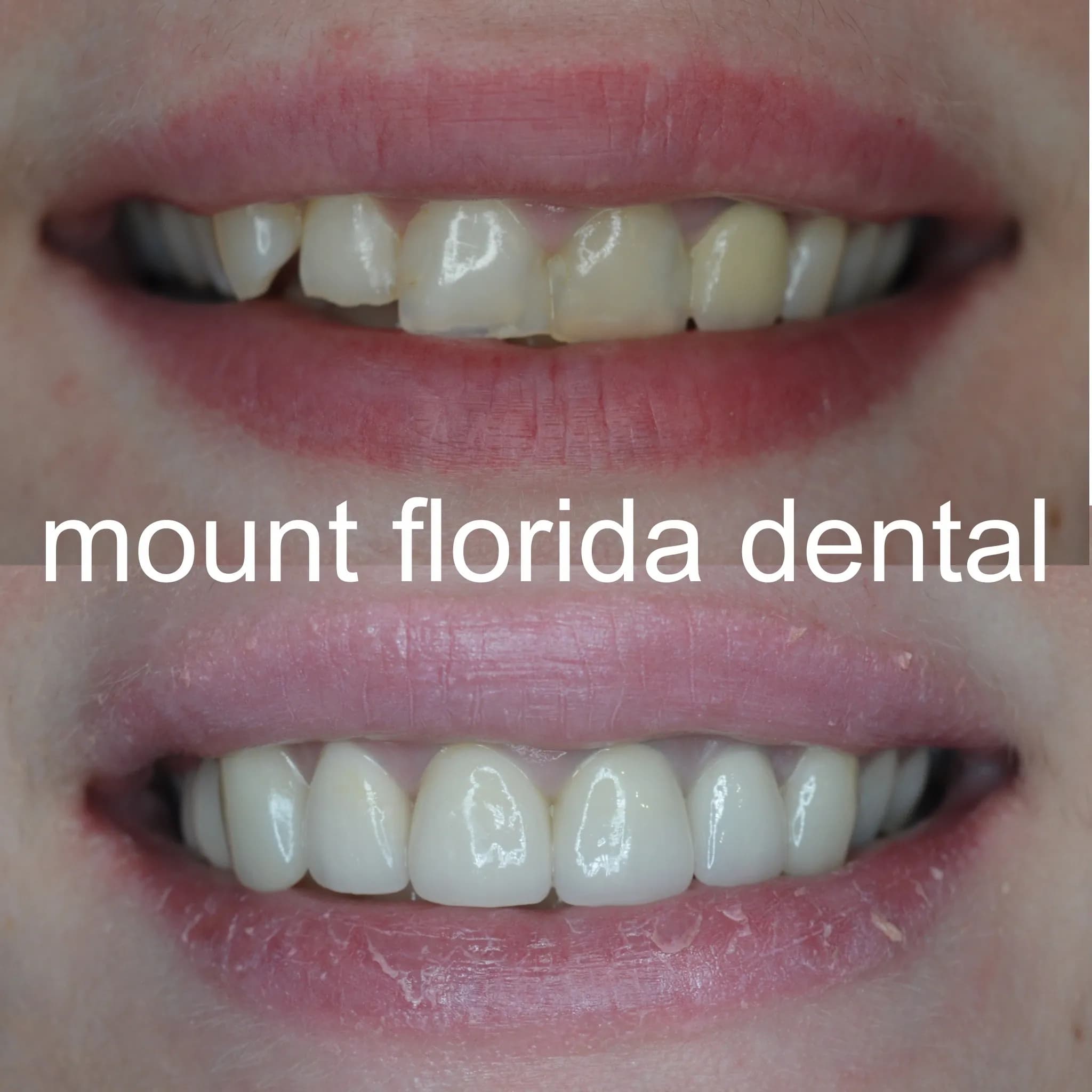 smile makeover with veneers and crowns