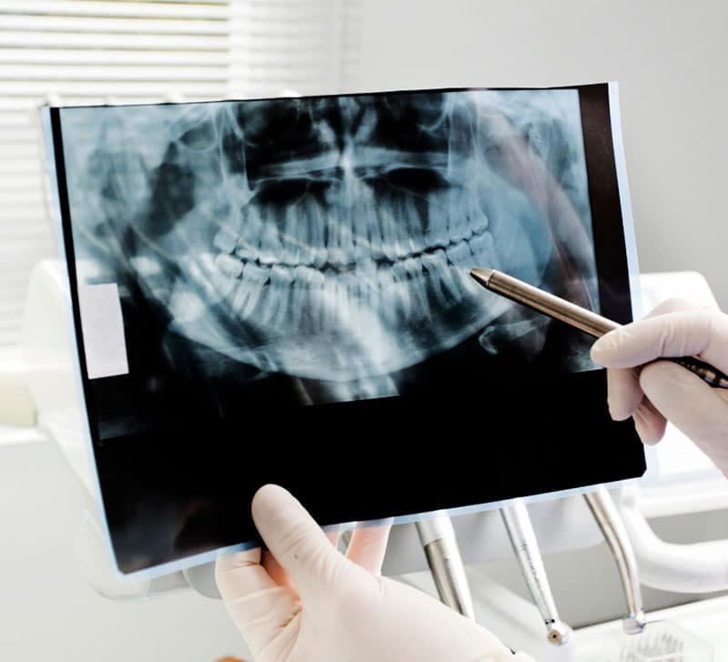 Dental X Ray