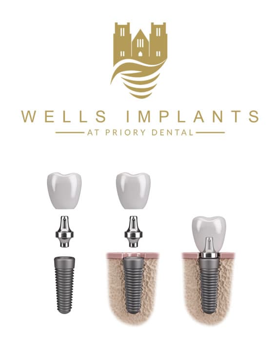 hp implants