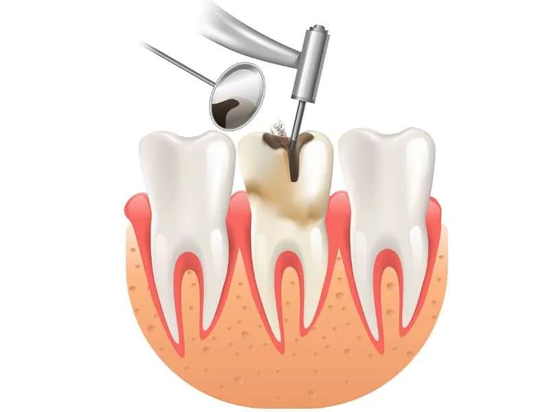 root canal dental treatment leixlip