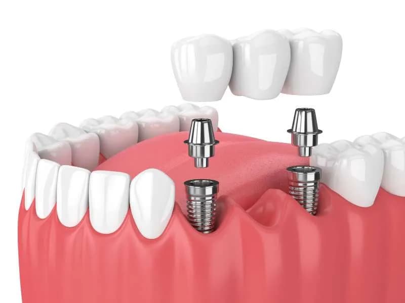 dental bridges leixlip