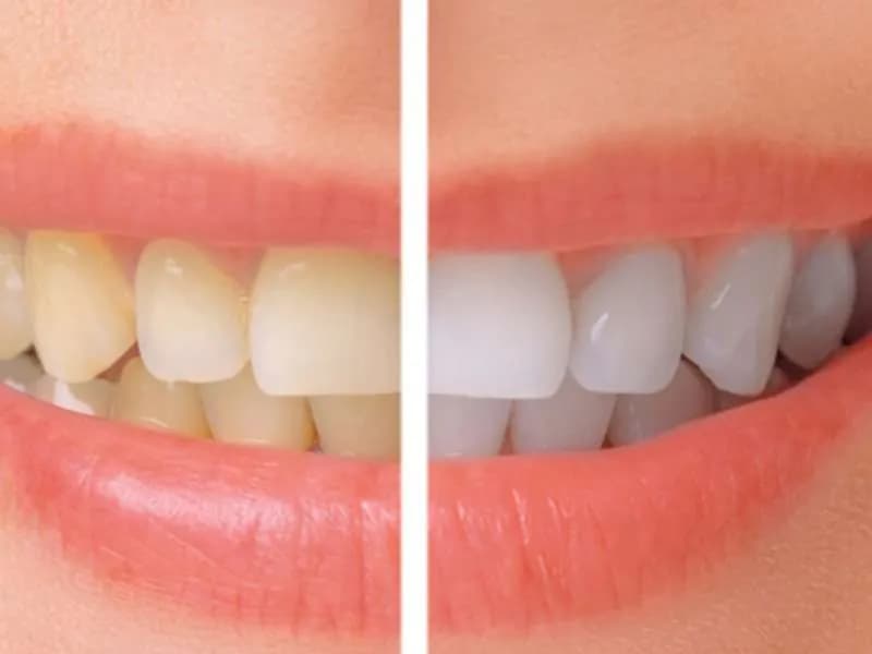 teeth whitening leixlip