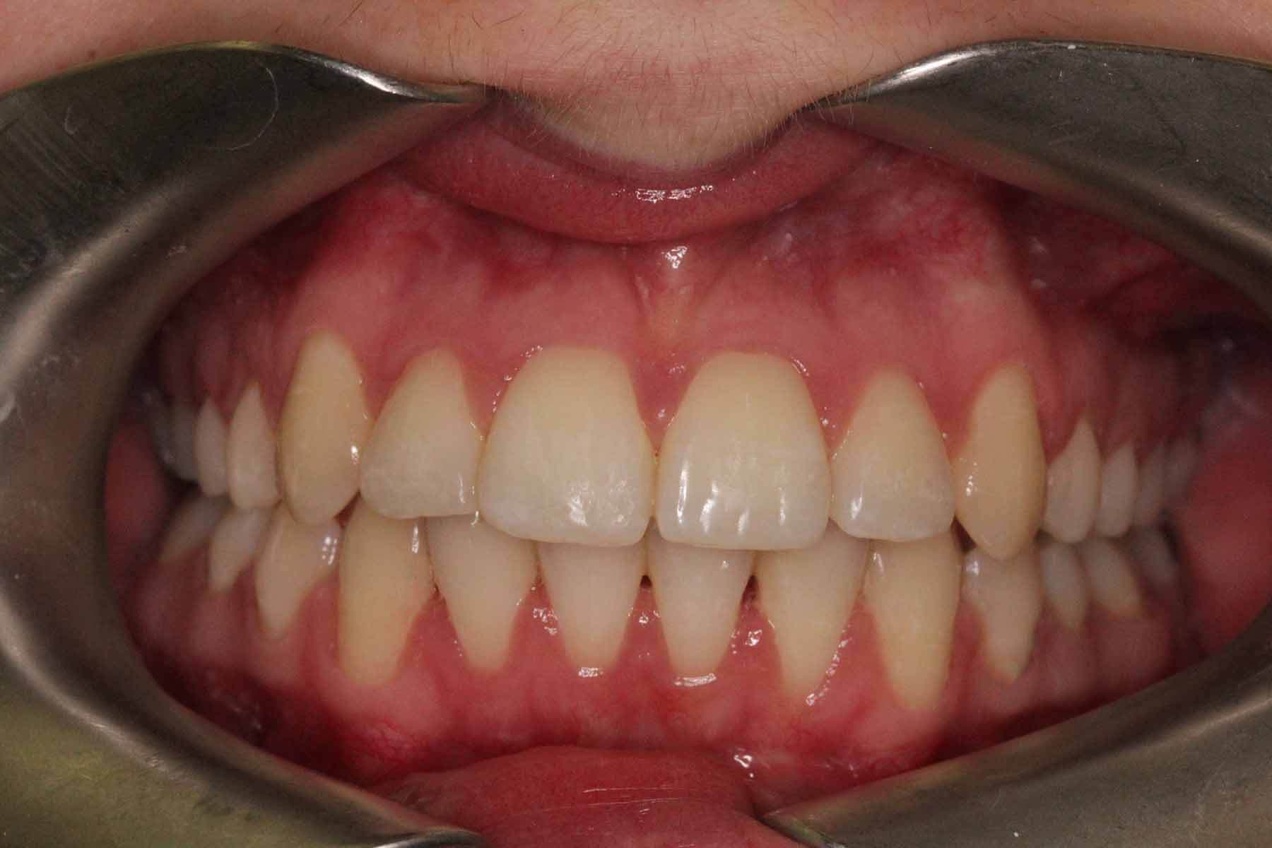 Priory Dentist orthodontist braces treatments before and after