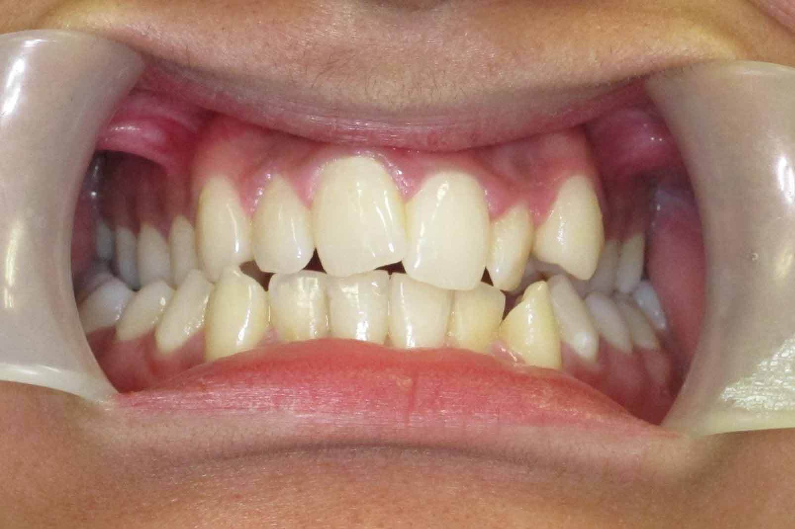 Priory Dentist orthodontist braces treatments before and after