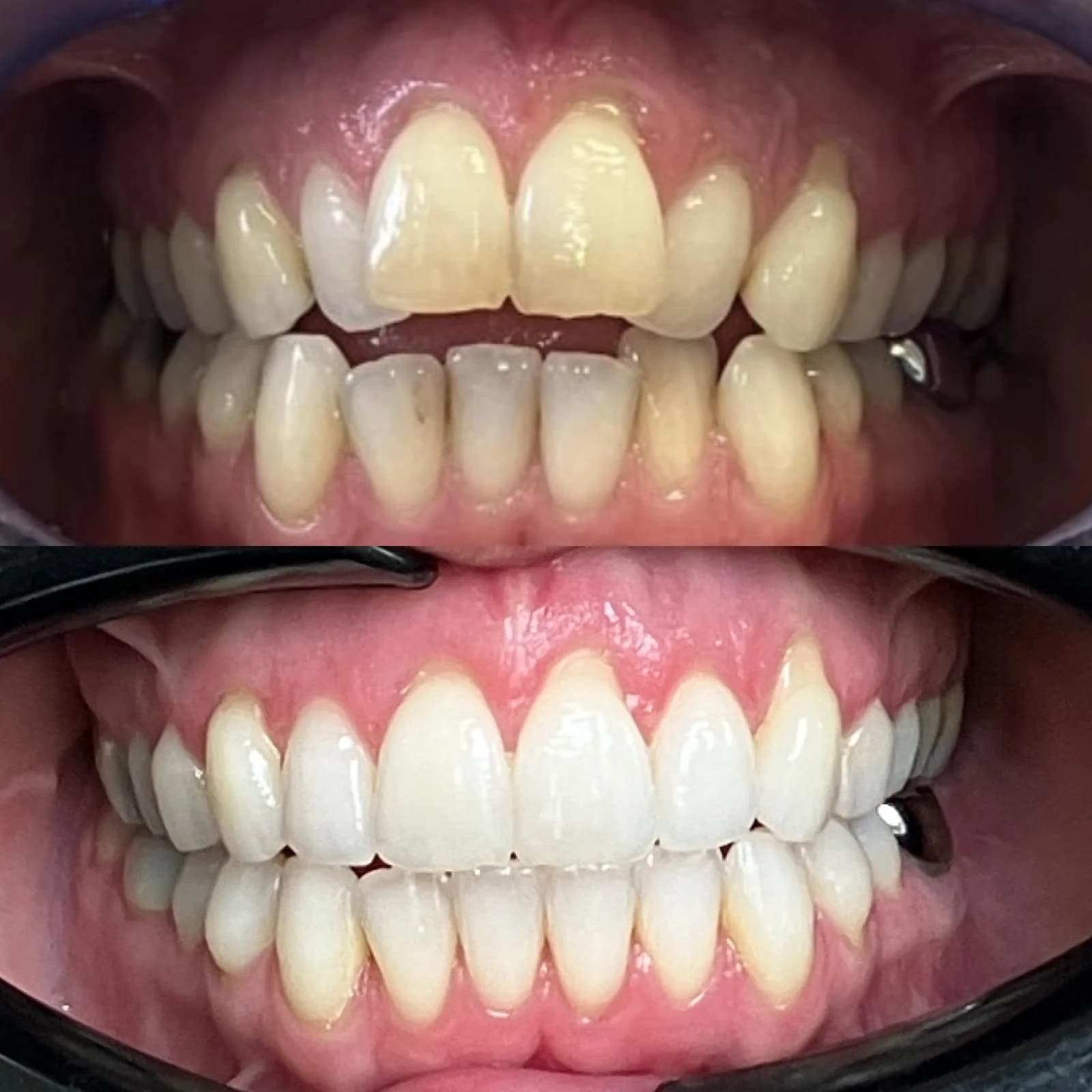 Invisalign Droitwich before and after case photo 2