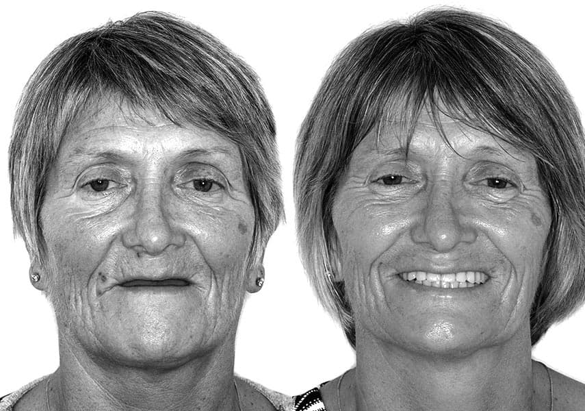 dental implants in essex dentalkind