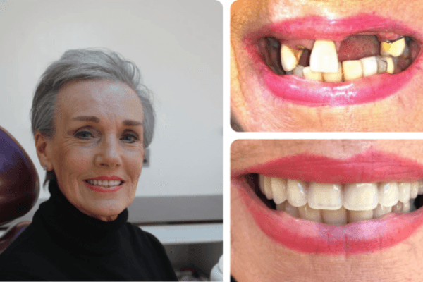 Dental Implant Case