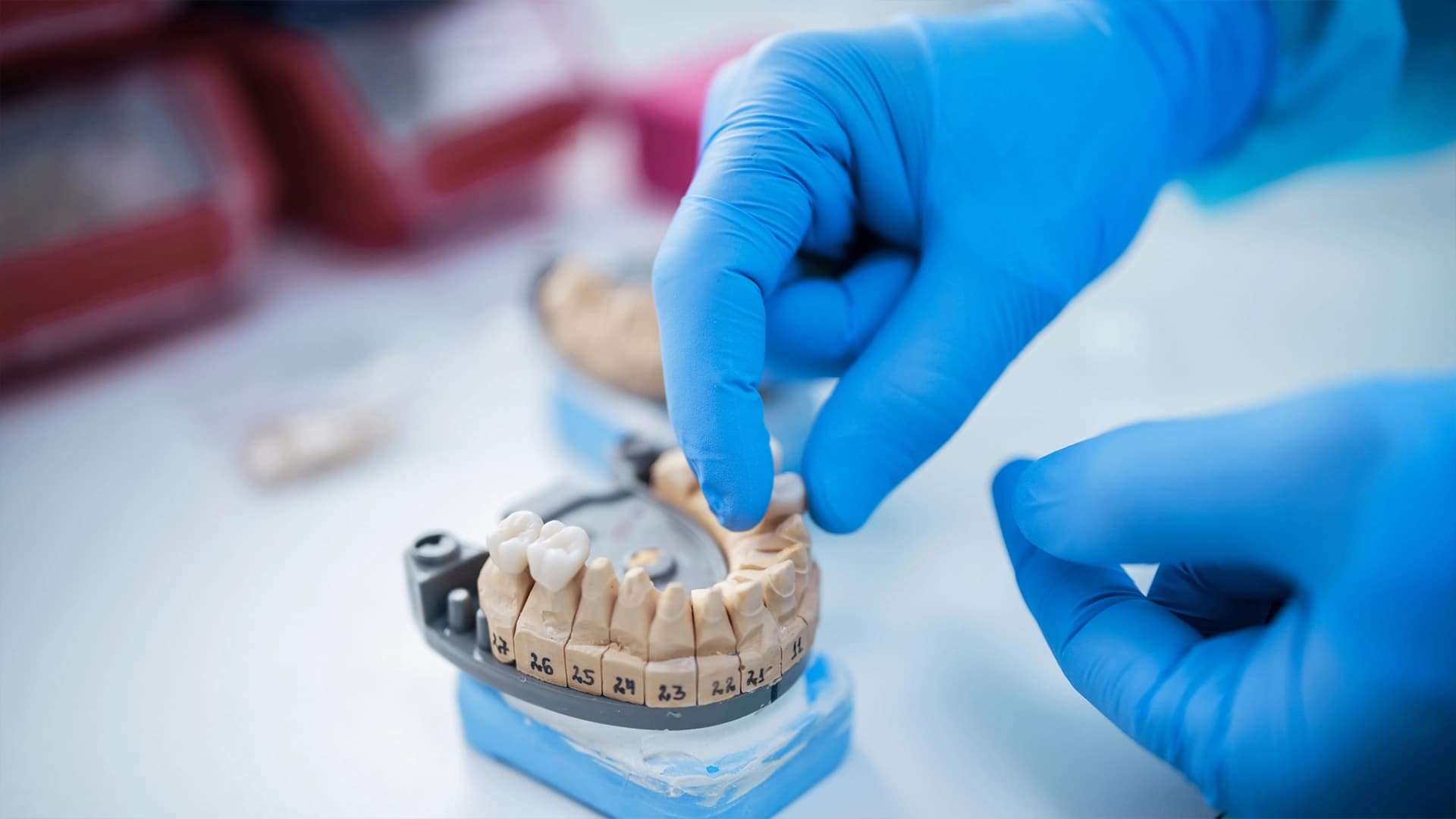 dental bridge