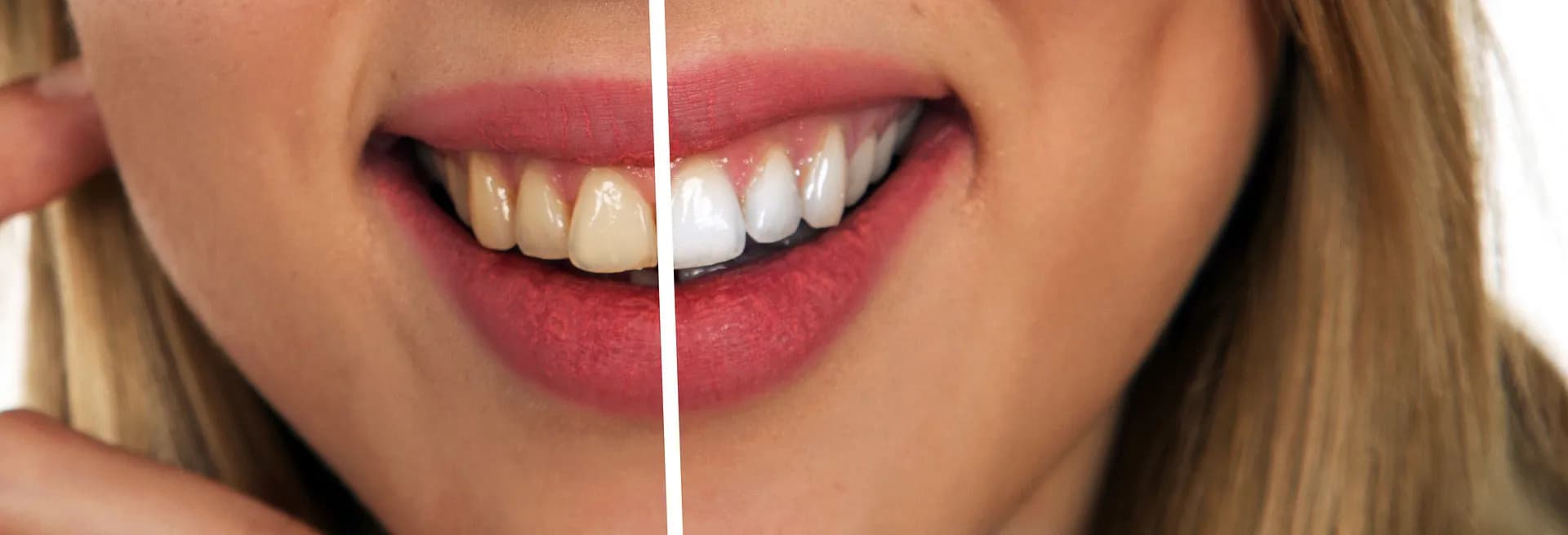 teeth whitening dentist, teeth whitening cambridge, best teeth whitening method, regent dental teeth whitening