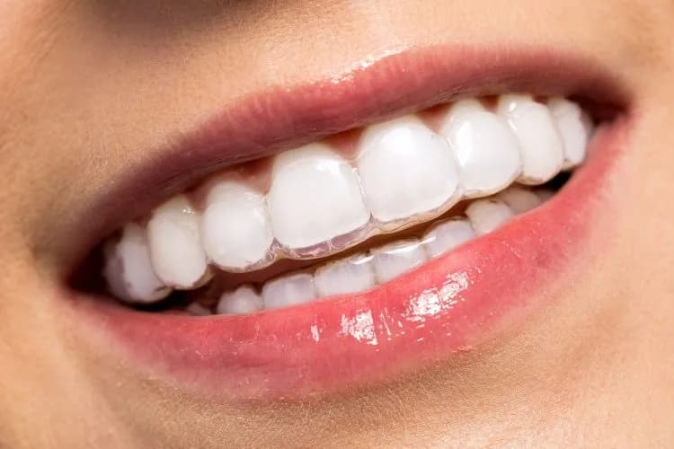 invisalign, invisalign bracers, invisible bracers cost, best invisalign bracers, invisalign dentist, invisalign dentist cambridge, invisalign cost nhs, invisalign nhs treatment, invisalign treatment, invisalign regent dental practice