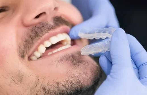 Invisalign 1